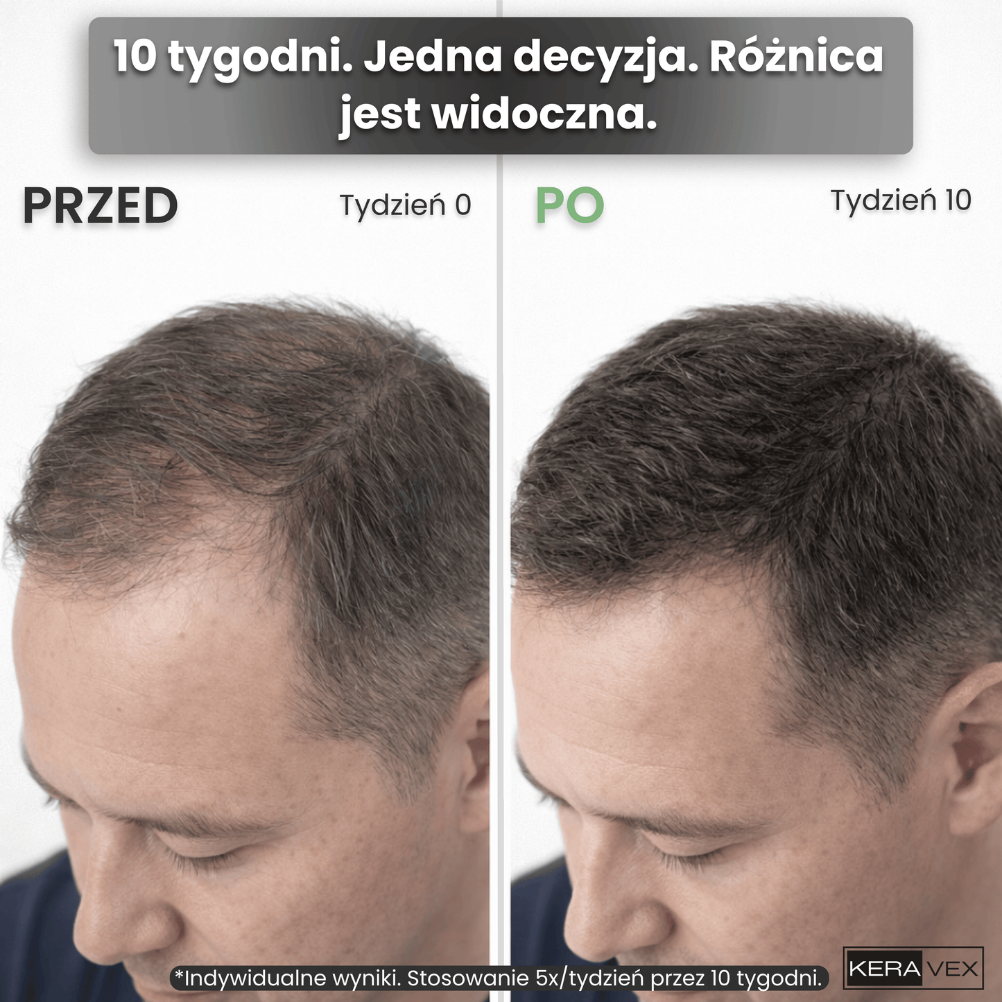 System Mikro Infuzji dla Wzrostu & Gęstości Włosów